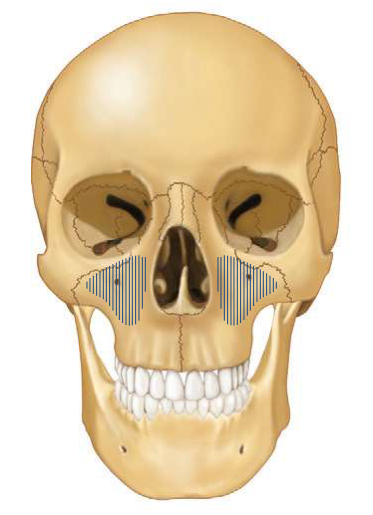 FIGURE 16-2 Anatomic position of the zygoma. A, Lateral skull demonstrating its articulation with the temporal, frontal, and maxillary bones. B, Frontal skull demonstrating its articulation with the maxillary, frontal, and sphenoid bones. The hatch marks demonstrate the extent of the maxillary sinus. Note that the zygoma forms the superolateral aspect of the sinus.