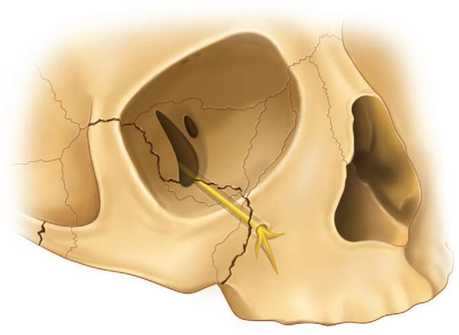 FIGURE 16-6 Typical fracture extends along or through the infraorbital groove or canal along the orbital floor and frequently across the infraorbital foramen on the facial surface of the maxilla. The orbital floor medial wall is frequently comminuted, with multiple lines of fracture crossing the infraorbital neurovascular bundle.
