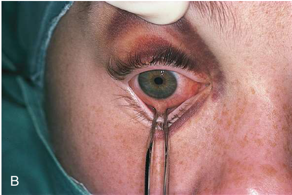 FIGURE 16-8 The forced duction test determines whether there is a physical impediment to ocular motility. A, Grasping of the inferior rectus muscle. B, Clinical photograph. (From Ward Booth P, Eppley BL, Schmelzeisen R: Maxillofacial trauma and esthetic facial reconstruction, ed 2, WB Saunders, St. Louis, 2012.)