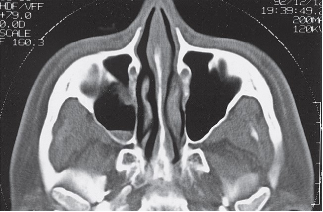 FIGURE 16-9 A - D, CT scans showing exquisite detail of a patient without a ZMC fracture demonstrating normal anatomy. A, Coronal CT scan through the medial orbital rim. One should be alert to the possibility of fractures in this area. If lateral displacement of the medial orbital rim goes unnoticed, proper alignment of the infraorbital rim will cause the ZMC to be laterally displaced. B, Coronal CT scan just posterior to the globe. The coronal scan is particularly useful for assessing the status of the medial wall and floor of the orbit. One should carefully compare the size of the orbits and the contour of the floor and walls. The coronal scan is also extremely useful for assessing the pos