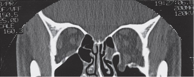 FIGURE 16-9 A - D, CT scans showing exquisite detail of a patient without a ZMC fracture demonstrating normal anatomy. A, Coronal CT scan through the medial orbital rim. One should be alert to the possibility of fractures in this area. If lateral displacement of the medial orbital rim goes unnoticed, proper alignment of the infraorbital rim will cause the ZMC to be laterally displaced. B, Coronal CT scan just posterior to the globe. The coronal scan is particularly useful for assessing the status of the medial wall and floor of the orbit. One should carefully compare the size of the orbits and the contour of the floor and walls. The coronal scan is also extremely useful for assessing the pos