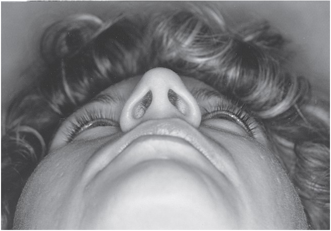 FIGURE 16-14 A, The reciprocal relationship between facial width and malar projection is demonstrated. Note that the normal contour of the zygomatic arch is straight, not curved. If the zygomatic arch is reconstructed with a bow, the malar eminence will lack anterior projection. Frontal (B) and submental (C) views of a patient who had open reduction and internal fixation of a right ZMC fracture 2 years previously. Note the increase in facial width and the decrease in malar projection. Also note the enophthalmos of the right globe. D, Axial CT scan showing lateral bowing of the zygomatic arch and the posterior position of the frontal process of the zygoma. One can see that the medial orbital 