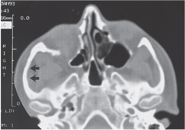 FIGURE 16-14 A, The reciprocal relationship between facial width and malar projection is demonstrated. Note that the normal contour of the zygomatic arch is straight, not curved. If the zygomatic arch is reconstructed with a bow, the malar eminence will lack anterior projection. Frontal (B) and submental (C) views of a patient who had open reduction and internal fixation of a right ZMC fracture 2 years previously. Note the increase in facial width and the decrease in malar projection. Also note the enophthalmos of the right globe. D, Axial CT scan showing lateral bowing of the zygomatic arch and the posterior position of the frontal process of the zygoma. One can see that the medial orbital 