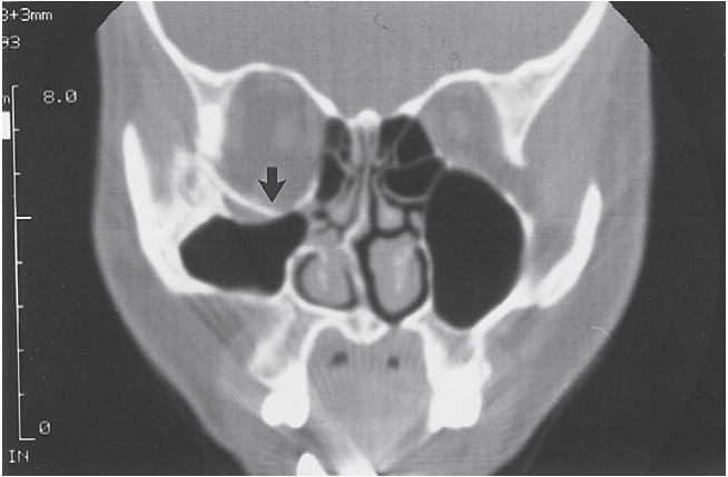 FIGURE 16-14 A, The reciprocal relationship between facial width and malar projection is demonstrated. Note that the normal contour of the zygomatic arch is straight, not curved. If the zygomatic arch is reconstructed with a bow, the malar eminence will lack anterior projection. Frontal (B) and submental (C) views of a patient who had open reduction and internal fixation of a right ZMC fracture 2 years previously. Note the increase in facial width and the decrease in malar projection. Also note the enophthalmos of the right globe. D, Axial CT scan showing lateral bowing of the zygomatic arch and the posterior position of the frontal process of the zygoma. One can see that the medial orbital 
