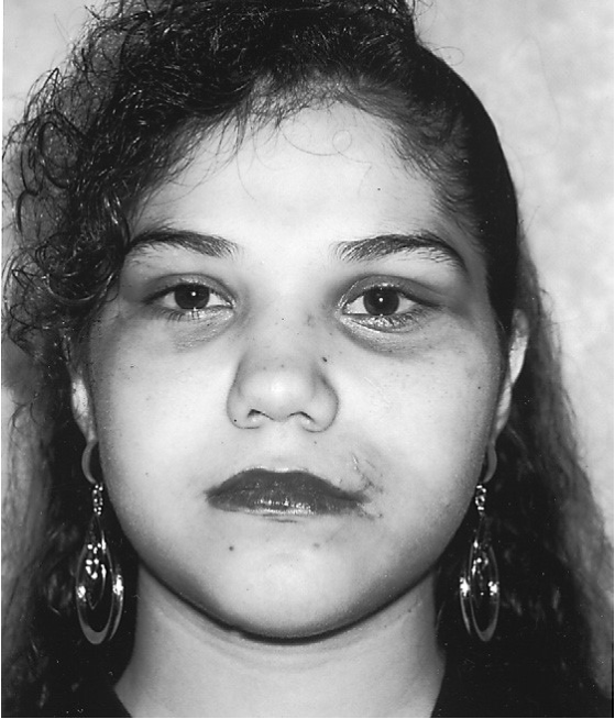 FIGURE 16-15 This patient was treated for a left ZMC fracture. Note lateral displacement of the ZMC and slight telecanthus on the left. This patient had an undiagnosed left nasal-orbital-ethmoid fracture, with lateral displacement of the frontal process of the maxilla. The left ZMC fracture was reduced to this bone, resulting in lateral displacement of the ZMC.