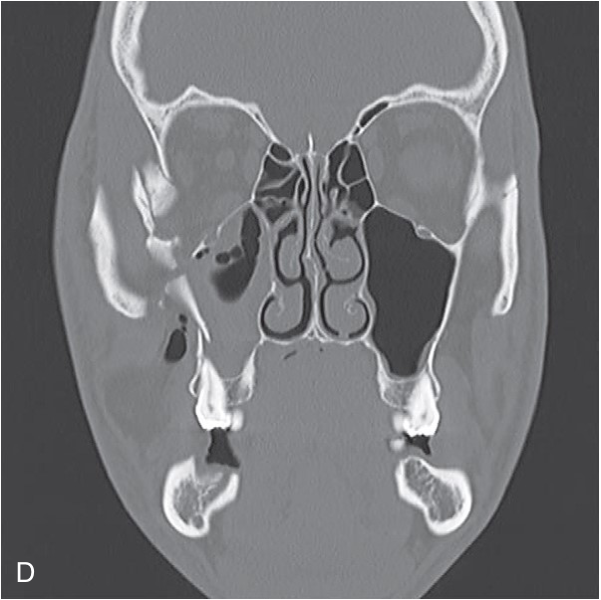 FIGURE 16-16 Use of intraoperative CT scanning. A, B, Preoperative three-dimensional CT scans show a moderately displaced right ZMC fracture. Note the lateral displacement of zygomatic arch and posterior displacement of malar eminence. C, D, Preoperative coronal CT scans show fractures of the orbital floor.