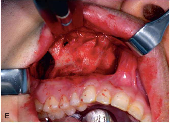 FIGURE 16-16, cont’d The ZMC fracture was exposed using maxillary vestibular (E) and upper eyelid approaches (F) . G, The ZMC was reduced using a Carroll-Girard screw. H, An intraoperative CT scan was then obtained to determine whether the reduction of the ZMC was adequate and to determine whether internal orbital reconstruction was necessary.