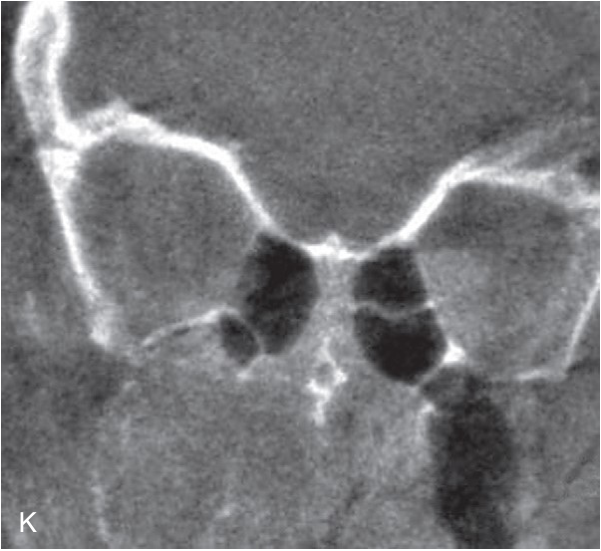 FIGURE 16-16, cont’d I, J, Intraoperative three-dimensional reconstructions demonstrated good reduction of the ZMC. Coronal (K) and sagittal (L) images of the orbit indicated that the orbital floor was in good position, so no internal orbital reconstruction was deemed necessary.