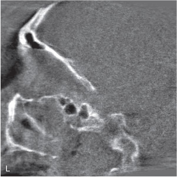 FIGURE 16-16, cont’d I, J, Intraoperative three-dimensional reconstructions demonstrated good reduction of the ZMC. Coronal (K) and sagittal (L) images of the orbit indicated that the orbital floor was in good position, so no internal orbital reconstruction was deemed necessary.