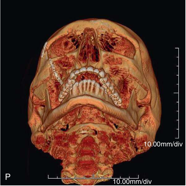 FIGURE 16-16, cont’d The ZMC was stabilized with bone plates across the zygomaticomaxillary buttress ( M ) and frontozyomatic suture areas ( N ) and the incisions closed. O, P, Q, Postoperative CT scans demonstrate good position of the ZMC and orbital floor ( R,S,T ).