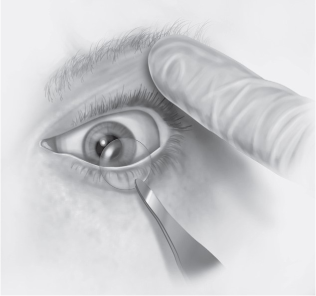 FIGURE 16-17 A, Scleral shell used for ocular protection. B, C, Technique of temporary tarsorrhaphy.