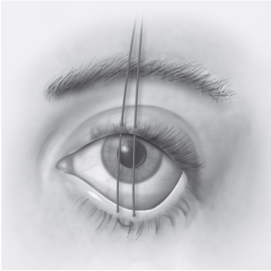 FIGURE 16-17 A, Scleral shell used for ocular protection. B, C, Technique of temporary tarsorrhaphy.