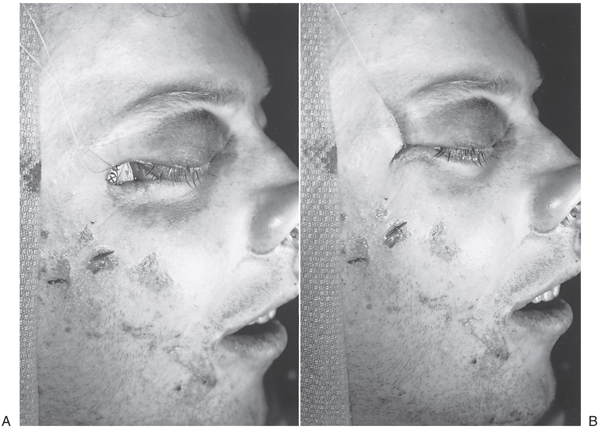 FIGURE 16-19 A, Appearance of malar soft tissue before resuspension. Note the 3-0 polyglycolic acid suture, which enters through the subciliary incision and passes through the periosteum and malar soft tissue. It is shown without being tied. B, Appearance of the malar soft tissue after the suture has been pulled superiorly. Note the elevation of the malar soft tissue mass and the support provided to the lower eyelid. This suture can be tied to one of the screws in a bone plate on the lateral orbital rim, through a hole through the orbital rim, or through the temporal fascia.
