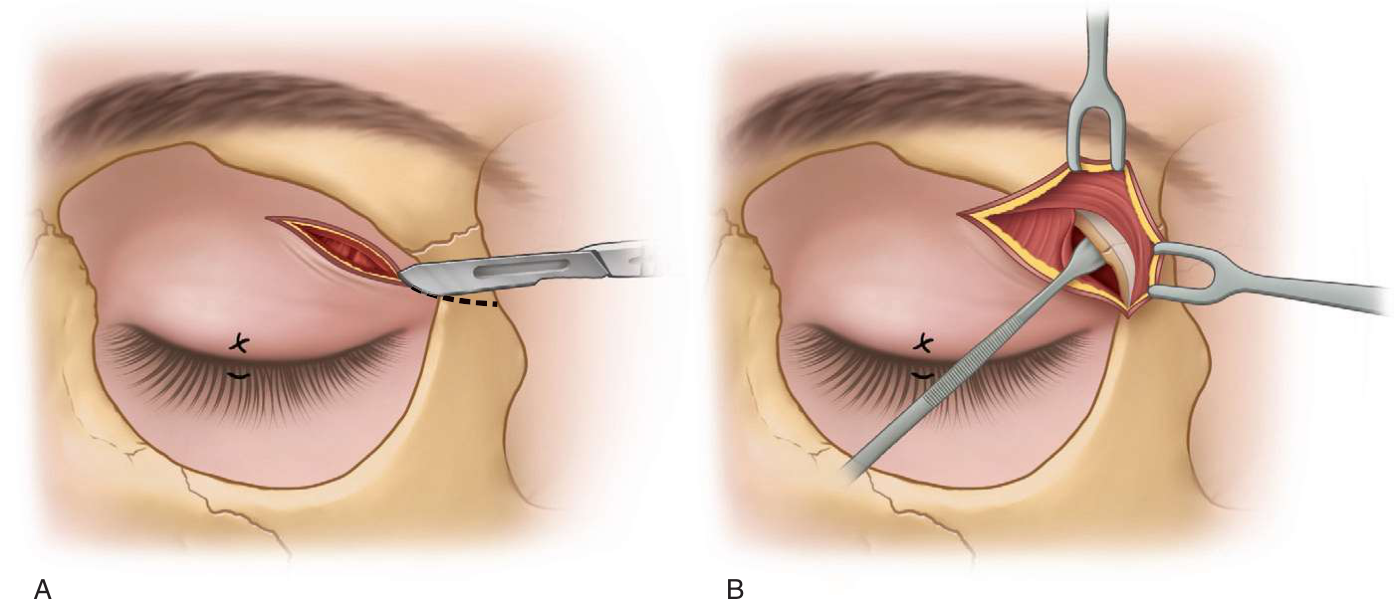 FIGURE 16-21 Supratarsal fold approach to the lateral orbital rim. A, Location of incision. B, Dissection into the medial orbit.