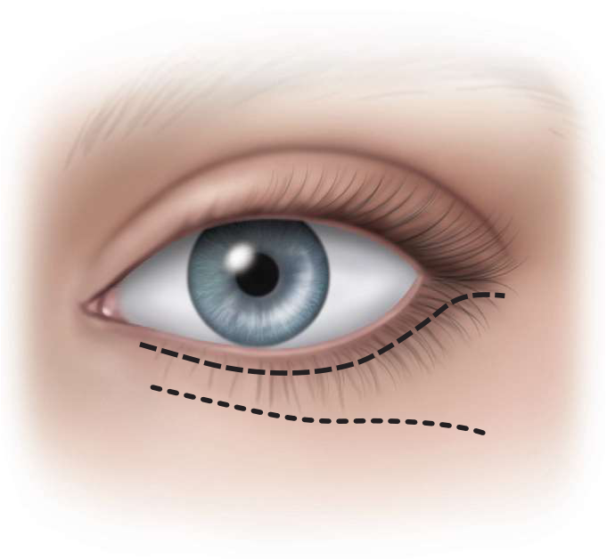 FIGURE 16-22 Incisions used to expose the infraorbital rim and orbital floor—subciliary (or blepharoplasty) incision (dashed line) and subtarsal incision (dotted line).