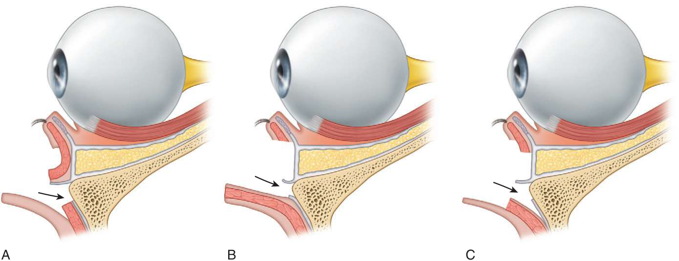 FIGURE 16-23 Cross-sectional anatomy of the dissection through the eyelid for the subtarsal (or subciliary) incision. A, Skin flap elevated from the orbicularis oculi muscle to just below the level of the infraorbital rim. An incision through the orbicularis oculi muscle and periosteum is then made. B, Skin-muscle flap dissected from the orbital septum to just below the level of the infraorbital rim, where an incision is then made through the periosteum. C, Three to 4 mm of skin are undermined before dissection through the orbicularis oculi muscle to the orbital septum, which is then followed inferiorly. The incision is then made through the periosteum.