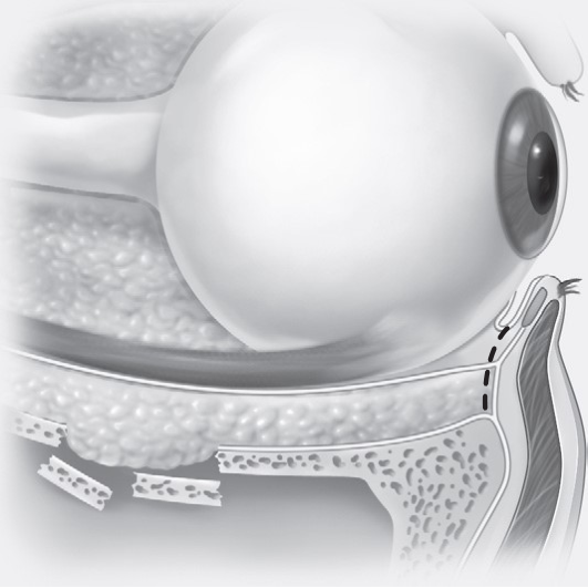 FIGURE 16-24 Transconjunctival incisions. A, Retroseptal approach. B, Preseptal approach. C, Initial full-thickness incision through the lateral canthus. D, Inferior cantholysis performed to release the lower eyelid.
