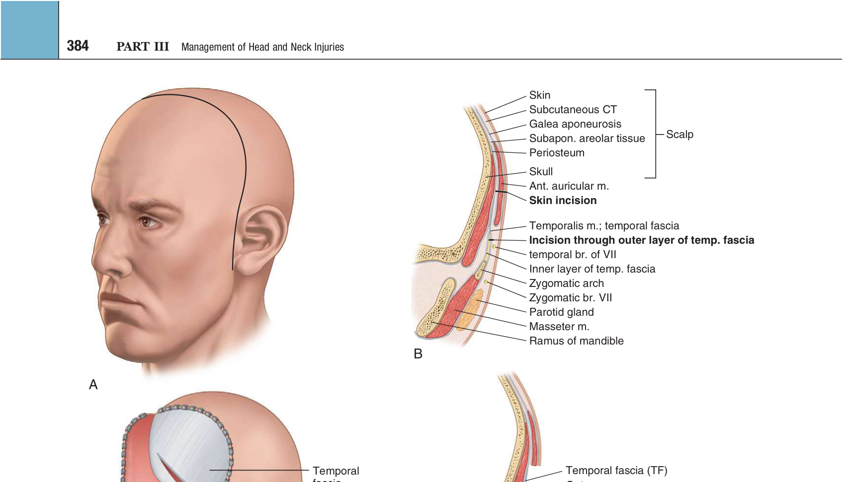 FIGURE 16-25 Coronal incision for exposure of ZMC fracture. A, Location of incision. The incision should be placed well behind the hairline. B, Anatomic layers of scalp and temporal area. C, Dissection of the flap anteriorly above the pericranium and temporal fascia. A second incision is made through the superficial layer of temporalis fascia and pericranium above the supraorbital rim. D, Anatomic layer of dissection through the superficial layer of temporalis fascia. Note that the temporal branch of the facial nerve is retracted laterally, protected by dissection in this plane. E, Subperiosteal dissection of the lateral orbit and zygomatic arch. F, Superficial layer of temporalis fascia is 