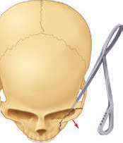 FIGURE 16-26 Gillies temporal approach to elevation of the zygoma. A, Initial incision to the level of the temporalis fascia. B, Second incision through the temporalis fascia to the underlying muscle. Note the muscle, which usually bulges out slightly through the incision. C, A flat periosteal elevator is inserted deep to the temporalis fascia (between the fascia and the muscle) and is swept anteriorly and posteriorly because it is advanced inferiorly. In this manner, the deep surface of the temporalis fascia is freed from the temporalis muscle. The periosteal elevator is advanced inferiorly until the medial surface of the zygomatic arch and temporal surface of the zygomatic body are identif