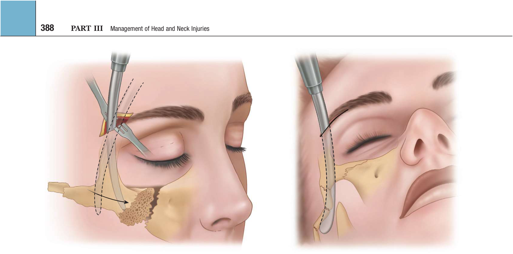 FIGURE 16-28 Elevation of ZMC from the eyebrow approach. A, Dingman zygomatic elevator is placed along the temporal surface of the zygoma for anterior, lateral, and superior elevation. B, Elevator is used to reduce the zygomatic arch fracture.