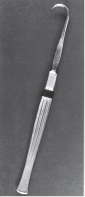 FIGURE 16-29 Elevation of the ZMC with a bone hook. A, Bone hook. B, Anterior and lateral traction with the use of a percutaneous bone hook. C, Clinical photograph of the use of a bone hook. The dotted lines on the face represent those discussed in the text. Note finger placement at the infraorbital rim during elevation to detect reduction.