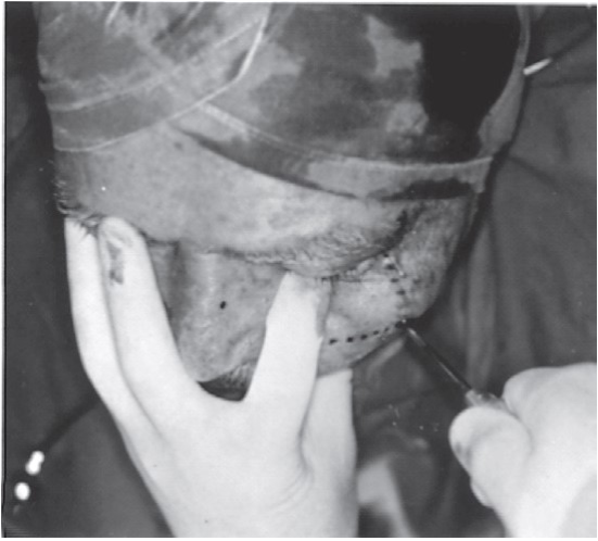 FIGURE 16-29 Elevation of the ZMC with a bone hook. A, Bone hook. B, Anterior and lateral traction with the use of a percutaneous bone hook. C, Clinical photograph of the use of a bone hook. The dotted lines on the face represent those discussed in the text. Note finger placement at the infraorbital rim during elevation to detect reduction.
