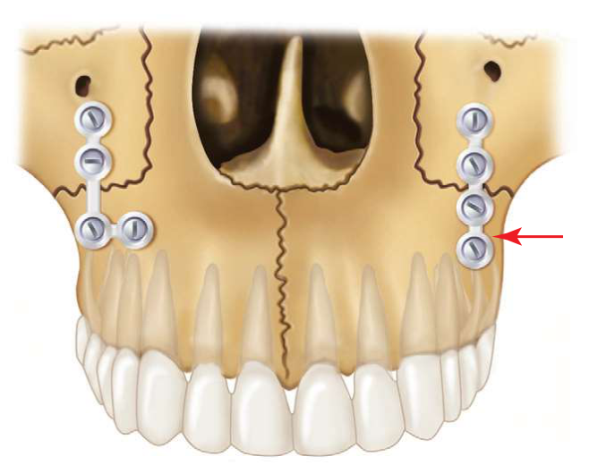 FIGURE 16-31 Vertical placement of two holes below the fracture at the zygomaticomaxillary buttress can jeopardize the tooth roots (right). In such cases, an L, T, or Y plate may avoid the tooth roots.