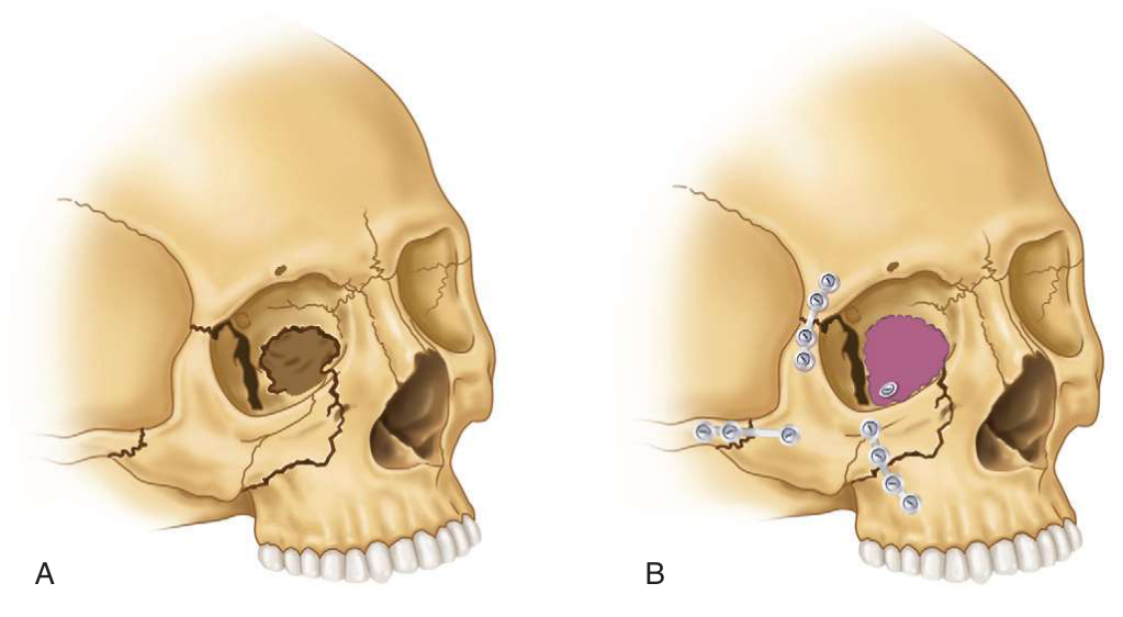 FIGURE 16-33 A, Right ZMC fracture with comminution of the orbital floor and medial wall. B, After reduction and internal fixation of the ZMC fracture, the internal orbit is reconstructed with a graft or implant that completely bridges the defect or comminuted area. C, Stabilization of the graft or implant is performed with a lag screw or by other means. D, Reconstruction of the left orbital floor and medial wall with the use of calvarial bone grafts secured with lag screws.