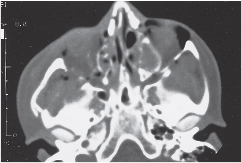 FIGURE 16-34 A, Patient sustained severe (high-energy) right ZMC and internal orbital fractures. B, Axial CT scan through the zygomatic arch shows retrusion of the entire ZMC and fracture of the arch at the junction with the articular eminence of the temporal bone. C, Axial CT scan showing posterior displacement of the ZMC. D, Coronal CT scan behind the globe showing disruption of the floor. E, Coronal exposure demonstrating reconstruction of the zygomatic arch and bone plate at the frontozygomatic suture area. F, After stabilizing the ZMC in position, a large orbital floor defect is present, with only the infraorbital nerve spanning it.