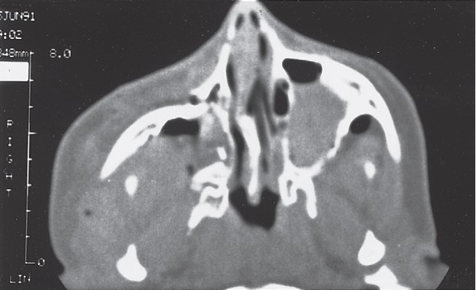 FIGURE 16-34 A, Patient sustained severe (high-energy) right ZMC and internal orbital fractures. B, Axial CT scan through the zygomatic arch shows retrusion of the entire ZMC and fracture of the arch at the junction with the articular eminence of the temporal bone. C, Axial CT scan showing posterior displacement of the ZMC. D, Coronal CT scan behind the globe showing disruption of the floor. E, Coronal exposure demonstrating reconstruction of the zygomatic arch and bone plate at the frontozygomatic suture area. F, After stabilizing the ZMC in position, a large orbital floor defect is present, with only the infraorbital nerve spanning it.