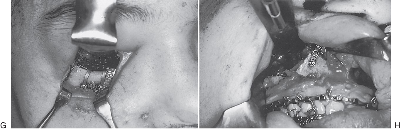 FIGURE 16-34, cont’d G, Orbital floor reconstruction bone plate used to span the defect. Autologous bone was placed on top of the plate. H, After repositioning the ZMC, a large defect of the lateral maxillary wall is present. Bone plates were used to span the defect. I, Bone grafts used to reconstruct the lateral maxillary wall. J, Resuspension of facial soft tissue performed before closure. This photograph shows resuspension of the outer layer of the temporalis fascia. K, Postoperative axial CT scans showing repositioning of the ZMC and reconstruction of the zygomatic arch (L).