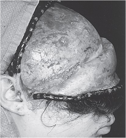 FIGURE 16-34, cont’d G, Orbital floor reconstruction bone plate used to span the defect. Autologous bone was placed on top of the plate. H, After repositioning the ZMC, a large defect of the lateral maxillary wall is present. Bone plates were used to span the defect. I, Bone grafts used to reconstruct the lateral maxillary wall. J, Resuspension of facial soft tissue performed before closure. This photograph shows resuspension of the outer layer of the temporalis fascia. K, Postoperative axial CT scans showing repositioning of the ZMC and reconstruction of the zygomatic arch (L).