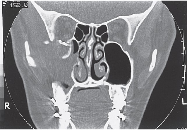 FIGURE 16-34, cont’d M, Alignment of the zygomaticosphenoid suture . N, Postoperative coronal CT scans show reconstruction of the orbital floor with metal plate and bone graft just posterior to the globe and, more posteriorly, in the orbit (O). Frontal (P), right (Q), and left (R) lateral photographs of patient 18 months after surgery.