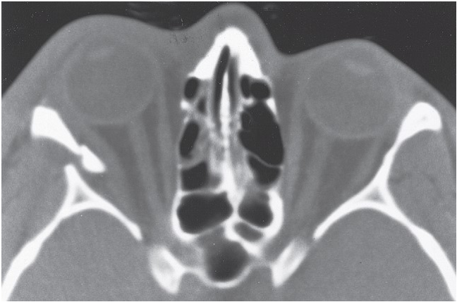 FIGURE 16-36 Patient with low-energy ZMC fracture treated with reduction using a Carroll-Girard screw without fixation. A, Frontal and inferior (B) views of the patient before surgery. Note the significant contour deficit present. C, Axial CT scan at the level of the midglobe shows displacement of the lateral orbital rim and disruption of the lateral orbital wall. D, Axial CT scan at the level of the zygomatic arch shows medial rotation of the posterior (infratemporal) surface of the ZMC into the maxillary sinus. E, Coronal scan posterior to the globe shows notable displacement of the ZMC, but minimal comminution of the orbital floor. After reduction, the position of the ZMC was thought to b