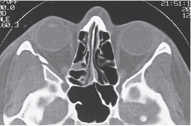 FIGURE 16-36 Patient with low-energy ZMC fracture treated with reduction using a Carroll-Girard screw without fixation. A, Frontal and inferior (B) views of the patient before surgery. Note the significant contour deficit present. C, Axial CT scan at the level of the midglobe shows displacement of the lateral orbital rim and disruption of the lateral orbital wall. D, Axial CT scan at the level of the zygomatic arch shows medial rotation of the posterior (infratemporal) surface of the ZMC into the maxillary sinus. E, Coronal scan posterior to the globe shows notable displacement of the ZMC, but minimal comminution of the orbital floor. After reduction, the position of the ZMC was thought to b