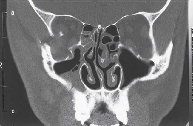 FIGURE 16-36 Patient with low-energy ZMC fracture treated with reduction using a Carroll-Girard screw without fixation. A, Frontal and inferior (B) views of the patient before surgery. Note the significant contour deficit present. C, Axial CT scan at the level of the midglobe shows displacement of the lateral orbital rim and disruption of the lateral orbital wall. D, Axial CT scan at the level of the zygomatic arch shows medial rotation of the posterior (infratemporal) surface of the ZMC into the maxillary sinus. E, Coronal scan posterior to the globe shows notable displacement of the ZMC, but minimal comminution of the orbital floor. After reduction, the position of the ZMC was thought to b
