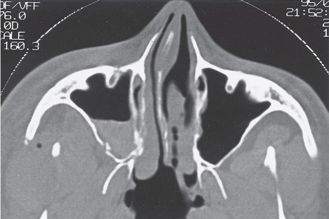 FIGURE 16-36, cont’d G, Postoperative axial CT scan at the level of the zygomatic arch shows satisfactory reduction. H, Postoperative axial CT scan just below the infraorbital rim shows good position of the malar eminence. I, Postoperative coronal CT scan at the posterior surface of the right globe shows satisfactory reduction of the fractures through the lateral orbital wall and floor. J, Coronal CT taken behind the right globe shows a satisfactory contour of the right zygomaticomaxillary buttress and maintenance of the contour of the orbital contents. Frontal (K) and inferior (L) views of patient 5 weeks later showing good symmetry.