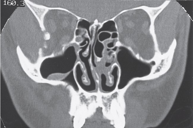 FIGURE 16-36, cont’d G, Postoperative axial CT scan at the level of the zygomatic arch shows satisfactory reduction. H, Postoperative axial CT scan just below the infraorbital rim shows good position of the malar eminence. I, Postoperative coronal CT scan at the posterior surface of the right globe shows satisfactory reduction of the fractures through the lateral orbital wall and floor. J, Coronal CT taken behind the right globe shows a satisfactory contour of the right zygomaticomaxillary buttress and maintenance of the contour of the orbital contents. Frontal (K) and inferior (L) views of patient 5 weeks later showing good symmetry.