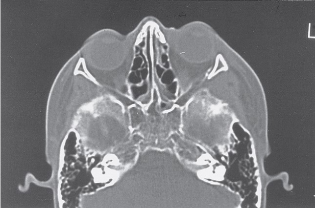 FIGURE 16-37 Patient with low-energy ZMC fracture treated by reduction using Carroll-Girard screw and bone plate fixation along the zygomaticomaxillay buttress. A, Frontal and inferior (B) views of patient with left ZMC fracture. C, Axial CT scan at midglobe level shows minimum displacement of the lateral orbital rim. D, Axial CT scan just below the infraorbital rim shows posteromedial displacement of the malar eminence. Note that the fractures are not comminuted. E, Coronal CT scan showing noncomminuted orbital floor and walls. The patient underwent reduction with a Carroll-Girard screw, but the malar eminence kept rotating inferomedially into the maxillary sinus. Transoral open reduction a