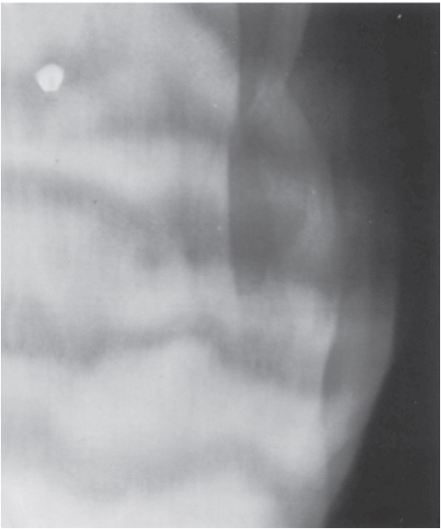 FIGURE 16-38 Reduction of a zygomatic arch fracture via the intraoral route. A, Preoperative photographs of the patient showing limited mandibular opening and a flattening over the left zygomatic arch (B). C, Preoperative intraoral tangential radiograph showing medial displacement of zygomatic arch fragments. D, Urethral sound inserted via a small incision in the maxillary vestibule. The instrument is placed medial to the zygomatic arch and the area of the displaced fracture is elevated while the other hand palpates along the arch (E).