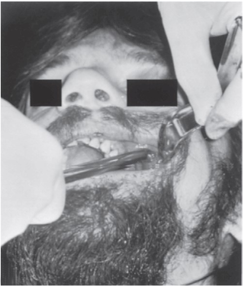 FIGURE 16-38 Reduction of a zygomatic arch fracture via the intraoral route. A, Preoperative photographs of the patient showing limited mandibular opening and a flattening over the left zygomatic arch (B). C, Preoperative intraoral tangential radiograph showing medial displacement of zygomatic arch fragments. D, Urethral sound inserted via a small incision in the maxillary vestibule. The instrument is placed medial to the zygomatic arch and the area of the displaced fracture is elevated while the other hand palpates along the arch (E).