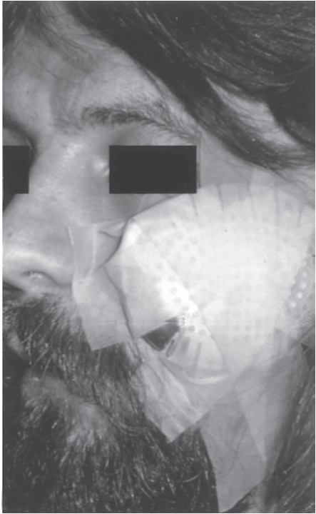 FIGURE 16-38, cont’d F, Postoperative radiograph showing reduction. G, Immediately postoperatively, patient has regained mobility of the mandible. H, Metal and gauze eye patches can be used to protect the reduced arch for several days (I).