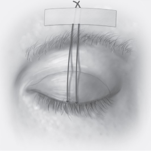 FIGURE 16-42 Frost suture placed through the skin of the lower lid and taped to the forehead to provide support to the lower lid.