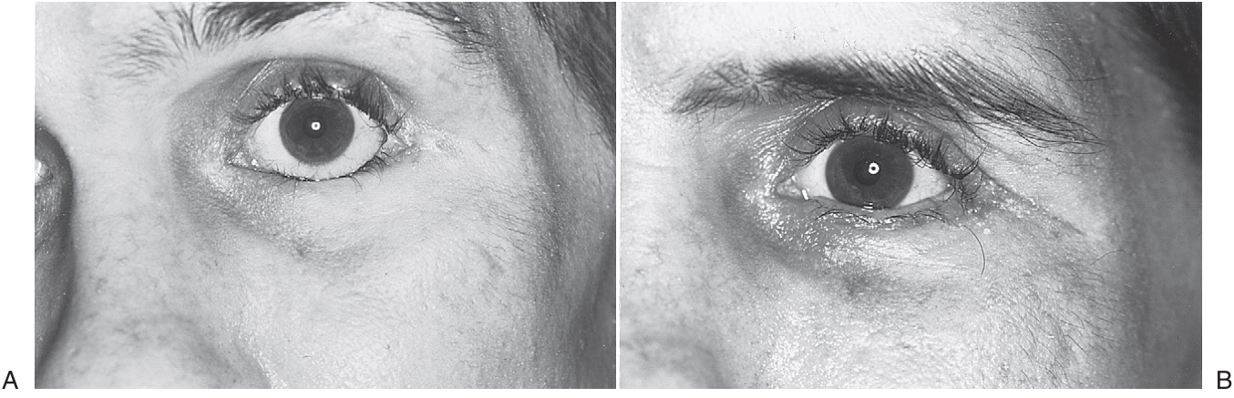 FIGURE 16-43 A, Patient 8 weeks after treatment of a left ZMC fracture through the transconjunctival approach with lateral canthotomy. Note 3 mm of scleral show, entropion, and the unnatural appearance of the lateral canthus, with the lid not touching the globe. B, Six weeks after surgical correction.