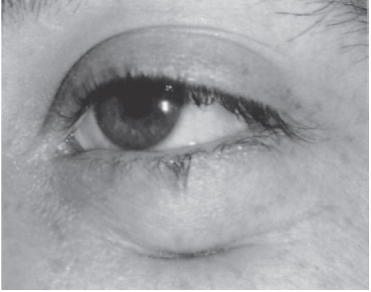 FIGURE 16-44 Patient who had a silicone implant used to reconstruct his orbital floor 13 months previously. A, For the past several months, he had intermittent swelling and drainage from this sinus tract. B, At surgery, the implant was found to be surrounded by chronic inflammatory tissue and was removed. The sinus tract was excised to gain access to the orbital floor. He had no further problems following implant removal.